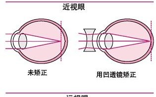 怎么样可以矫正近视眼，怎么样可以矫正近视眼呢