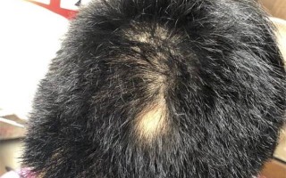 班秃头怎么样可以长头发出来，班秃头怎么样可以长头发出来小孩